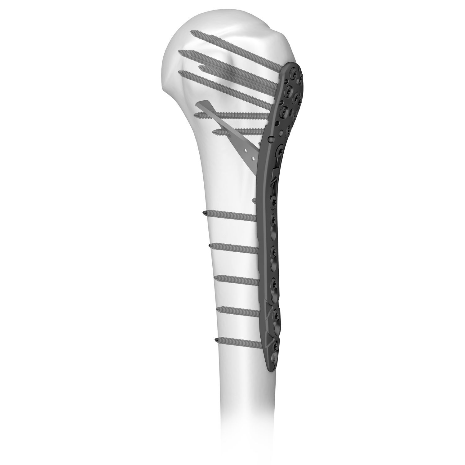 Kompressionsplatte F R Humerus Series Boneunion Medical