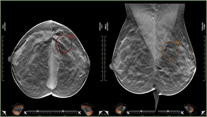 CAD Software MEDI FUTURE für Mammographie Onkologie zur