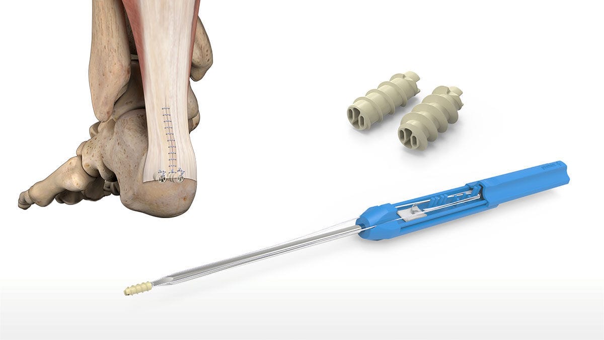 Achillessehne Fadenanker S Acumed F R Ligamentum