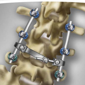 Stabilisierungssystem für Osteosynthese / Lumbosakral / dorsaler Zugang / für Erwachsene