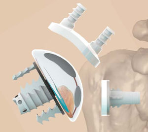 Humeruskopfprothese
