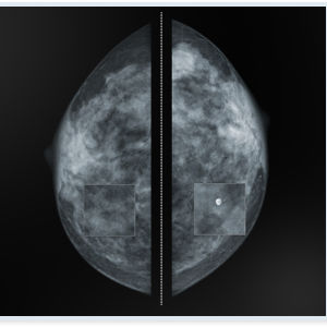 Mammographie-Software / zur Bildverbesserung / Visualisierung / Diagnose
