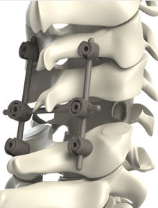 Stabilisierungssystem für Osteosynthese / HWS / posterior / für Kinder