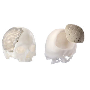 patientenspezifisches Schädelimplantat