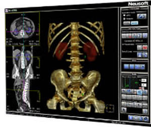 Visualisierungssoftware / Analyse / Urologie / TDM