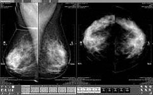 Diagnose-Software / Analyse / Mammographie