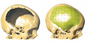 patientenspezifisches Schädelimplantat