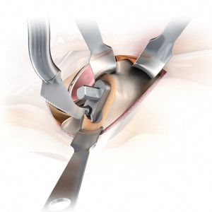Instrumentenset / minimal invasive Hüftchirurgie