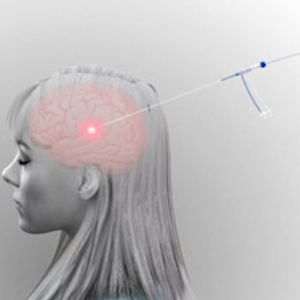 Laser-Ablationssystem / für Thermo-Ablation von Zerebraltumoren / IRM geführt