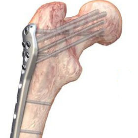 Knochen-Kompressionsplatte / Oberschenkelknochen / proximal