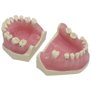Anatomisches Modell / Gebiss / für Ausbildung / Pathologie / Parodontitis