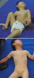 Orthopädischer Body / Zur Haltungskorrektur / Pädiatrie