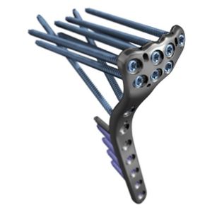 Knochen-Kompressionsplatte / Tibia / proximal