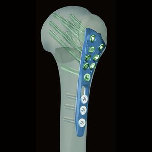 Knochen-Kompressionsplatte / Humerus / proximal