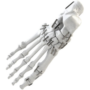 Orthopädische Klammer / Tarsalknochen / Zehen / Metatarsophalangealgelenk / Metatarsalknochen