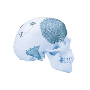 Schädelimplantat