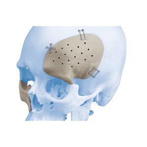 patientenspezifisches Schädelimplantat
