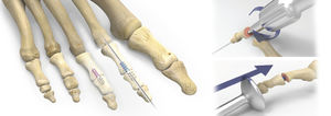 Knochen-Kompressionsschraube / Arthrodese Interphalangealgelenk des Fußes / kanüiert