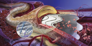 Thoraxaorta Stentgraft / aus ePTFE