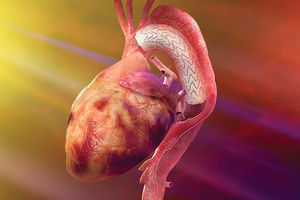 Thoraxaorta Stentgraft / Kunststoff