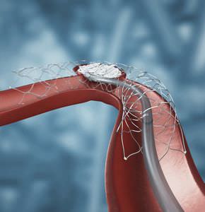 Intrakranieller Stent / Nitinol / Stütz für Embolisationsspirale
