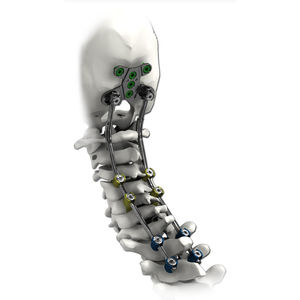 okzipito-zervikothorakales Stabilisierungssystem für Osteosynthese / dorsaler Zugang / für Erwachsene