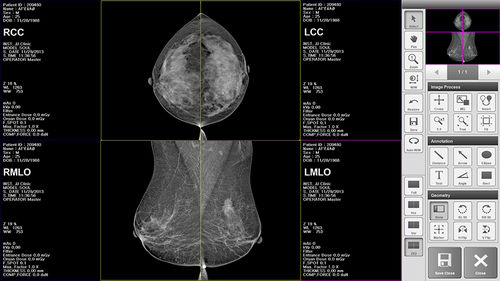 Software für Mammographie BRESTATION LITE MEDI FUTURE Bildanalyse