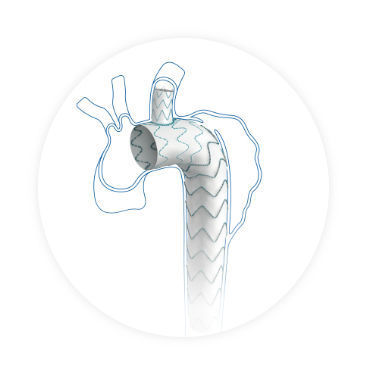 Aortenbogen-Stentgraft - Castor - Endovastec - Nitinol / Polyethylen