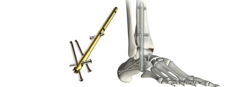 Tarsalknochen-Marknagel - VALOR® - Wright Medical Technology