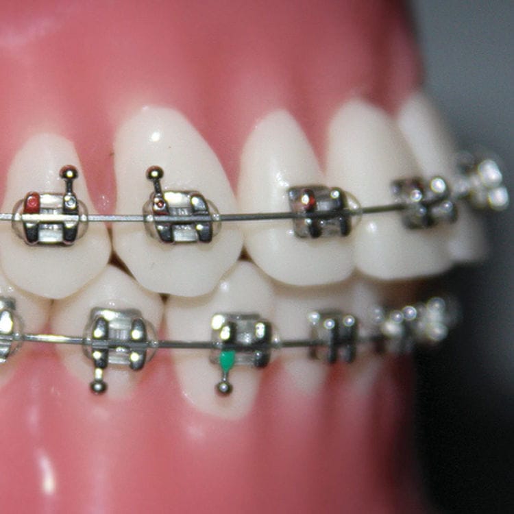 Orthodontie Bracket / Metall Focus™ G&H Orthodontics Mini