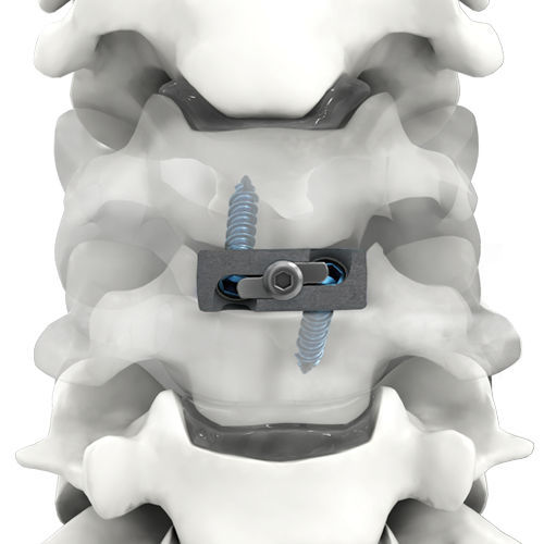 HWSZwischenwirbelimplantat PROLINK® Life Spine ventraler Zugang / Titan