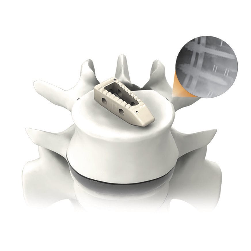Thorakolumbales Zwischenwirbelimplantat PLATEAU®P Life Spine