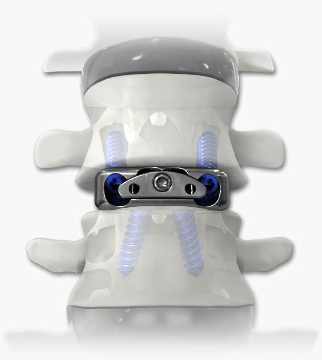 HWSZwischenwirbelimplantat DYNALINK® Life Spine ventraler Zugang / Titan