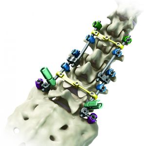 Stabilisierungssystem für Osteosynthese / Brust Lendenwirbelsäule und Kreuzbein 1