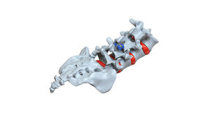 Interspinales Wirbelkörperimplantat / LWS