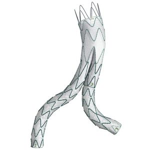 Stentgraft / Aorta abdominalis