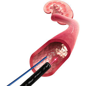 Nierenarterie-Stent