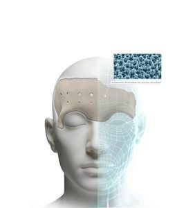 3D-gedrucktes Implantat, ästhetisch