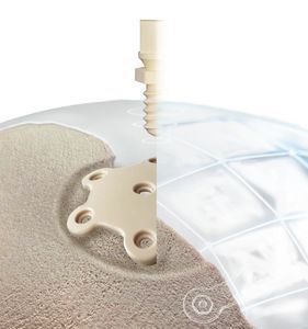 patientenspezifisches Schädelimplantat