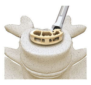 LWS-Zwischenwirbelimplantat