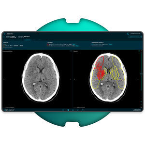 Software für Schlaganfalldiagnostik