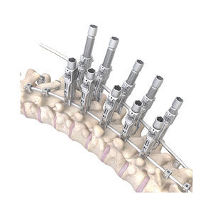 thorako-lumbales Stabilisierungssystem für Osteosynthese