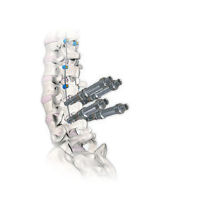 thorako-lumbales Stabilisierungssystem für Osteosynthese 1