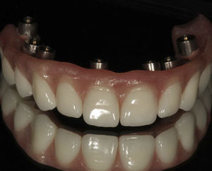 Acrylzahnprothese 1