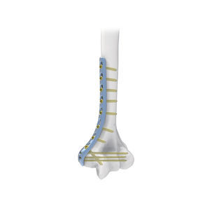 Kompressionsplatte für Humerus 1