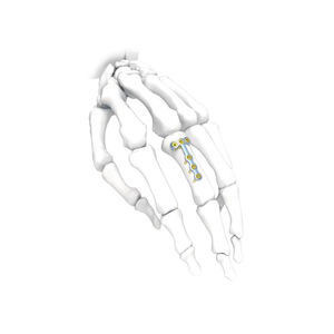 Kompressionsplatte für Hand 1