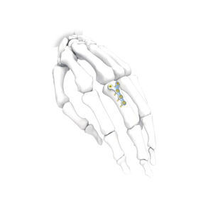 Kompressionsplatte für Hand 1