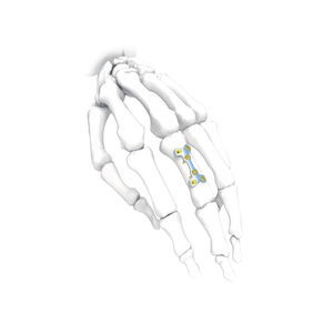 Kompressionsplatte für Hand 1