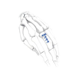 Kompressionsplatte für Hand 1
