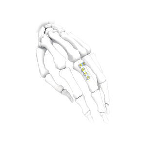 Kompressionsplatte für Hand 1